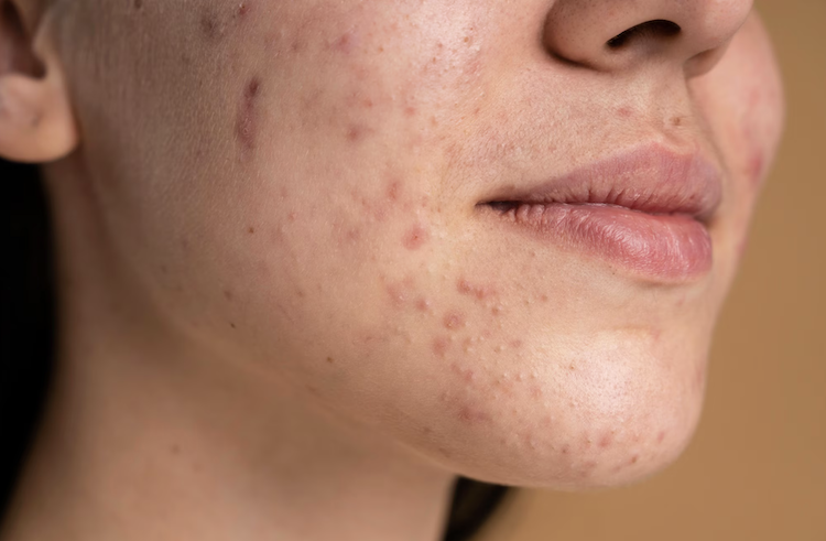 Acne treatments in Parker Colorado