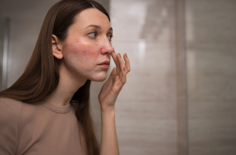 Rosacea Treatments in Parker Colorado